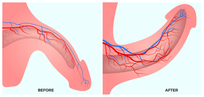 Erectile Dysfunction Little Rock ED Treatment in Little Rock